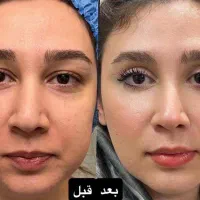 بلفاروپلاستی پلک