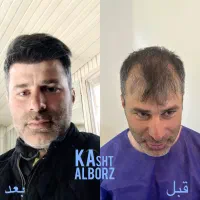 کاشت مو و ابرو تخصصی با قیمت استثنایی