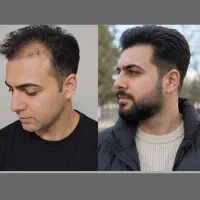 معجزه رویش موهات