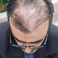 تخفیف استثنایی کاشت مو و ابرو|خدمات آرایشگری و زیبایی|یاسوج, |دیوار