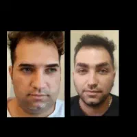 جراحی پلک ، تزریق ژل و بوتاکس. آنزیم . کامپوزیت
