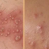 چگونه با سیستم ایمنی قوی پیشروی زگیل و تبخال
