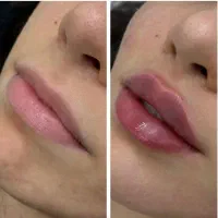 خدمات تخصصی ، ژل ، بوتاکس، لیزر در مطب دکتر شریفی