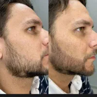 ریشات کم پشته راه هلش اینجاست