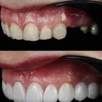 جشنواره وتخفیفات ویژه ایمپلنت/با شرایط اقساطی