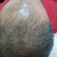 رویش مجدد مو بدون جراحی