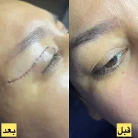 جشنواره تزریق چربی جراحی پلک بلفارو ساکشن غبغب