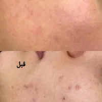 الکترولیز ،لاغری موضعی، فیشیال، رفع افتادگی پلک