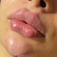 تزریق بوتاکس و فیلر صورت و فیلر بدن