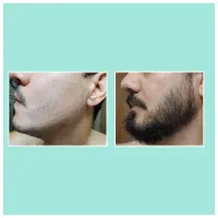 کاشت ریش ممنوع شد