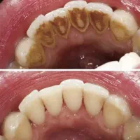جرم گیری و بلیچینگ