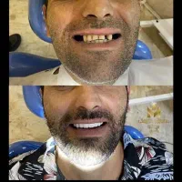 دندان ثابت