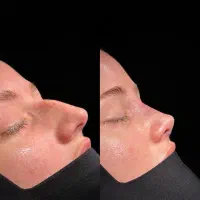 جشنواره ویژه جراحی بینی