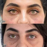 بلفاروپلاستی (جراحی افتادگی پلک بالا)شرایط چکی