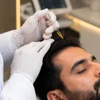 پی آر پی سر و صورت با نرخ مناسب