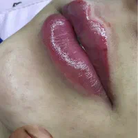 تزریق ژل و بوتاکس