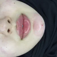 ژل و بوتاکس و خال برداری