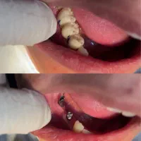 ایمپلنت با روکش ۲۳۹۰۰ کره ای با روکش سرامیک