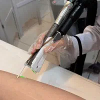 لیزر شاتی بدون درد