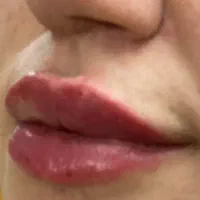 جشنواره فیلرلب زاویه فک بوتاکس،لیفت بانخ،مزووایت