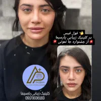جشنواره عیدانه/بوتاکس/فیلر/مزوتراپی/تخفیف