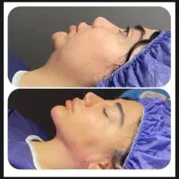 لیپو ۳۶۰ ابدو مامو پلاستی ژنیکو پروتز اقساطی