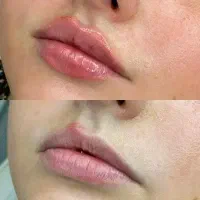 مادلینگ صورت باپک ده سی سی فقط 7/900 فیلربوتاکس ژل