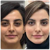 جوانسازی پوست، درمان لک صورت، جای جوش و اسکار