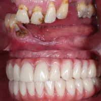 دندان پزشکی اوردنچر دو فک اقساطی