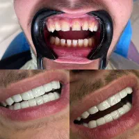 کامپوزیت دندان حرفه‌ایVIP بابهترین کیفیت از فکی 14