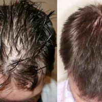 دیگه نیاز به قرص کاشت نداری