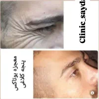 بوتاکس فول فیس. بوتاکس زیر بغل.بوتاکس گامی اسمایل