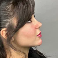 عمل جراحی بینی با(پیزوسرجری)در کرج و تهران