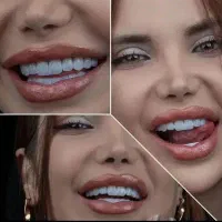 ایمپلنت کامپوزیت لمینیت بلیچینگ اقساط