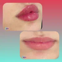 خدمات ویژه پاییزه ژل-بوتاکس-فیلر-مزوژل