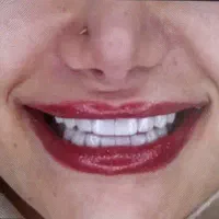کامپوزیت لمینت جرمگیری