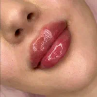 مدل تزریق ژل و بوتاکس و آموزش در کلینیک زیبایی