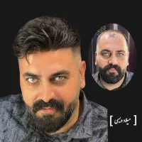 پروتز ترمیم مو تخصصی میلاد ویسی مشاوره رایگان