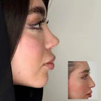 جراحی بینی در تهران ویژه مراجعین پلدختر/۴۳میلیون