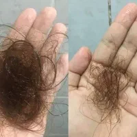 دنبال قطع کردن ریزش موهاتی