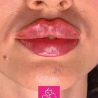 خدمات ژل و بوتاکس وفیلربادی و هیپ دیپ