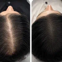 میکرو اسکالپ سر ، پوشش طاسی و کم پشتی مو