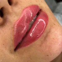 مدل تزریق ژل لب با پزشک