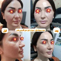 لیفت وجوانسازی با نخ و تزریق فیلروبوتاکس