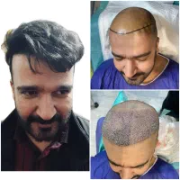 کاشت مو فقط ۱۲ میلیون