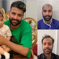کاشت مو طبیعی تراکم بالا