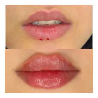خدمات زیبایی ژل و بوتاکس،مزو،خالبرداری،رفع شلی و .
