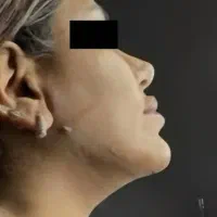 بلفارو4،بوتاکس550،غبغب4 توسط پزشک زیبایی