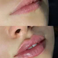تزریق حرفه‌ای ژل و بوتاکس با فرم‌دهی طبیعی چهره