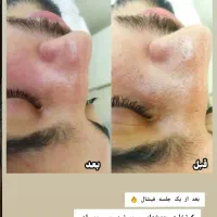 خدمات فیشال ماساژ پیرسینگ پی ار پی مزوتراپی